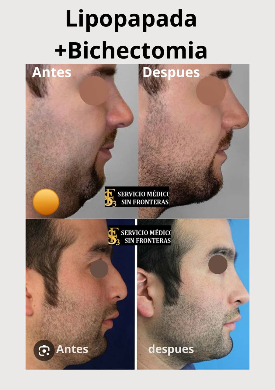 Resultado Bichectomía 2